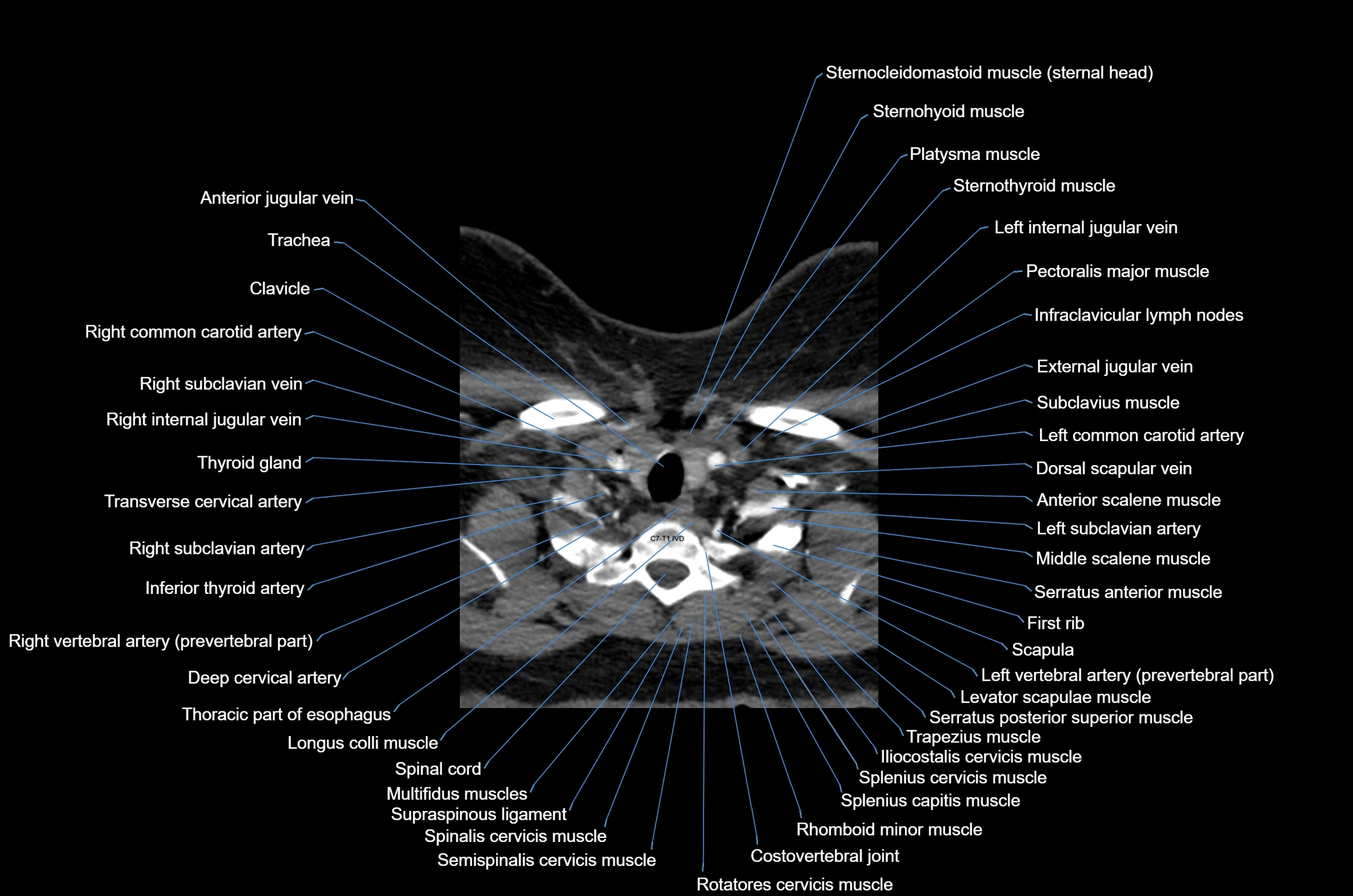 CT Neck axial cross sectional anatomy radiology image-img-00001-00053.webp